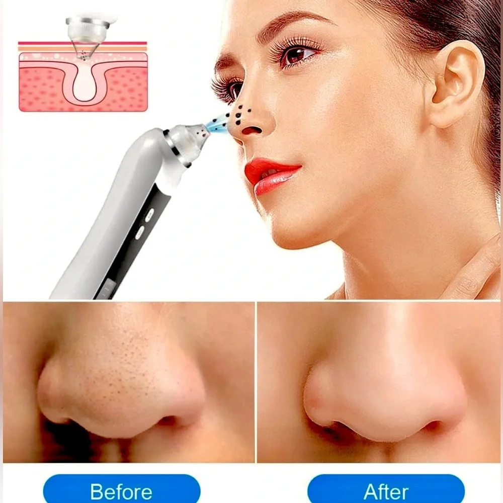 Petrichor Professional Pore Vacuum Blackhead Remover
